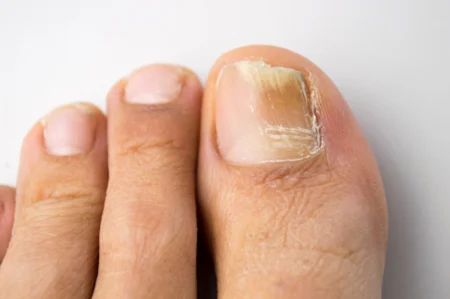 mycose ongle de pied