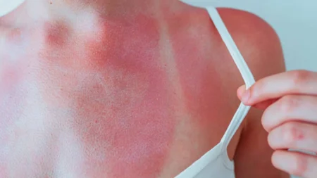 Santé de la peau en été : prévenir les effets du soleil